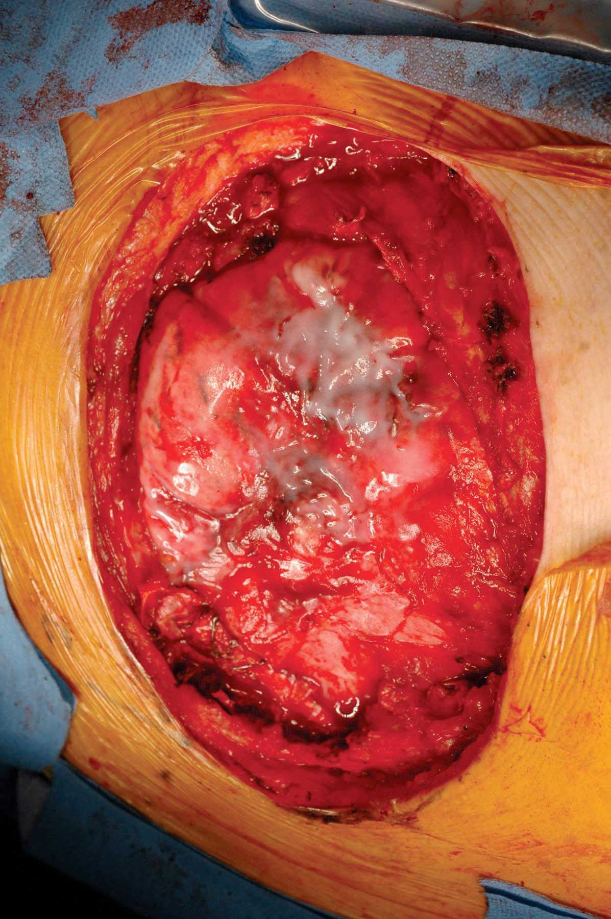 Left Mastectomy Wound Closure with Left Latissimus Dorsi