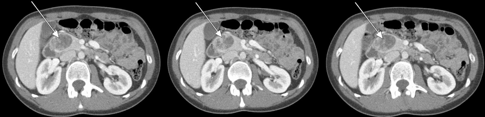 Abdominal CT revealing a 3.5-cm enhancing lesion associated with the head of the pancreas.