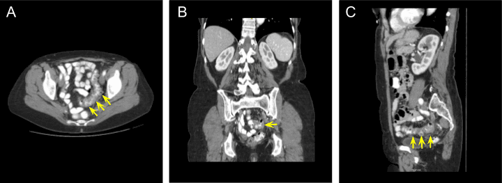 CT scan of the abdomen and pelvis with intravenous and oral contrast revealing evidence of uncomplicated sigmoid diverticulitis. The diseased tissue is shown in (A) axial, (B) coronal, and (C) sagittal views. Yellow arrows point to the diseased segment of colon.