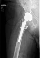 Less Invasive Stabilization System (LISS) for Distal Femur Fracture Repair