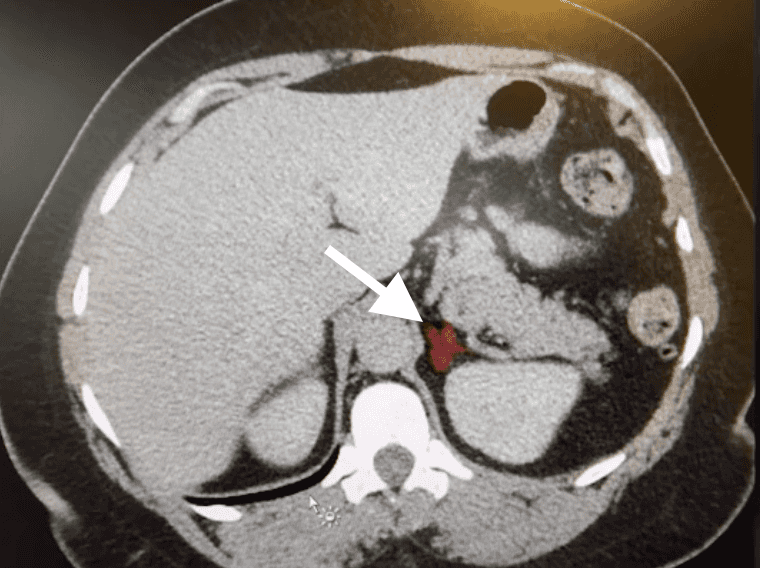 Figure 1.Abdominal CT
Non-contrast CT image revealing a lesion (white arrow) in the area of the left adrenal gland.