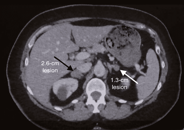Figure 1. Non-contrast abdominal CT revealing a 2.6-cm lesion consistent with a right adrenal mass (black arrow), and a 1.3-cm lesion consistent with a left adrenal mass (white arrow).