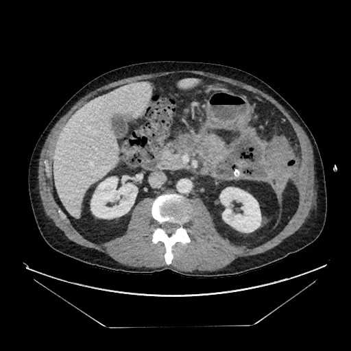 CT scan of the patient showing a necrotic collection in the vicinity of the pancreatic tail containing air and with percutaneous drain present.