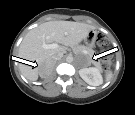Transverse view of nodule within right thyroid lobe; white arrows denote microcalcifications.