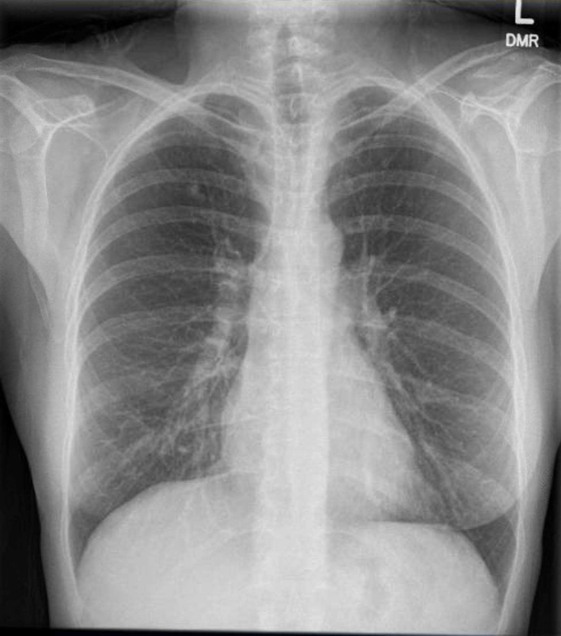 171_Figure3_CXR