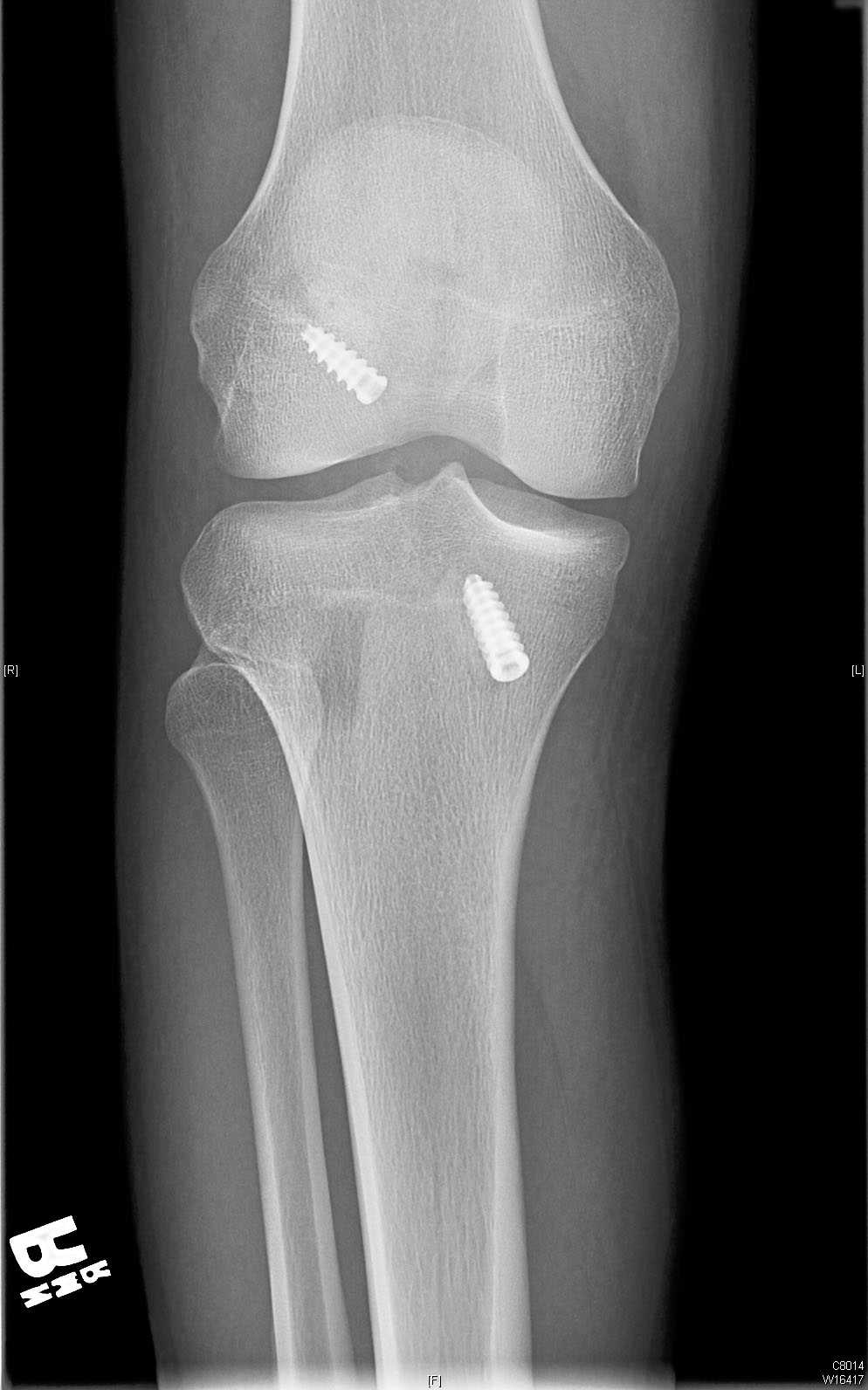 Knee X Ray After Acl Surgery - Corben Hanson