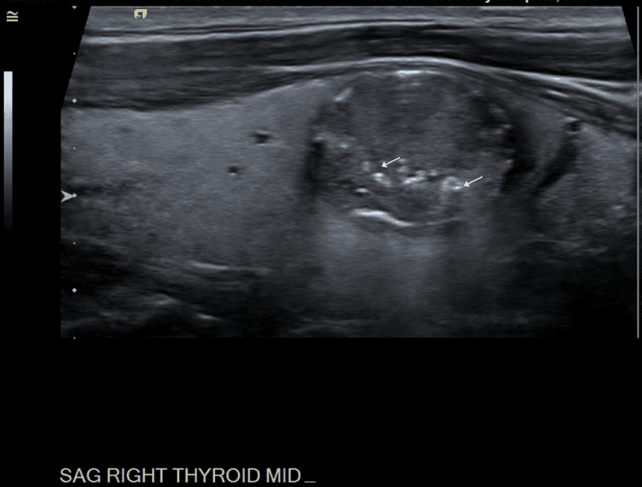 Sagittal view of nodule.