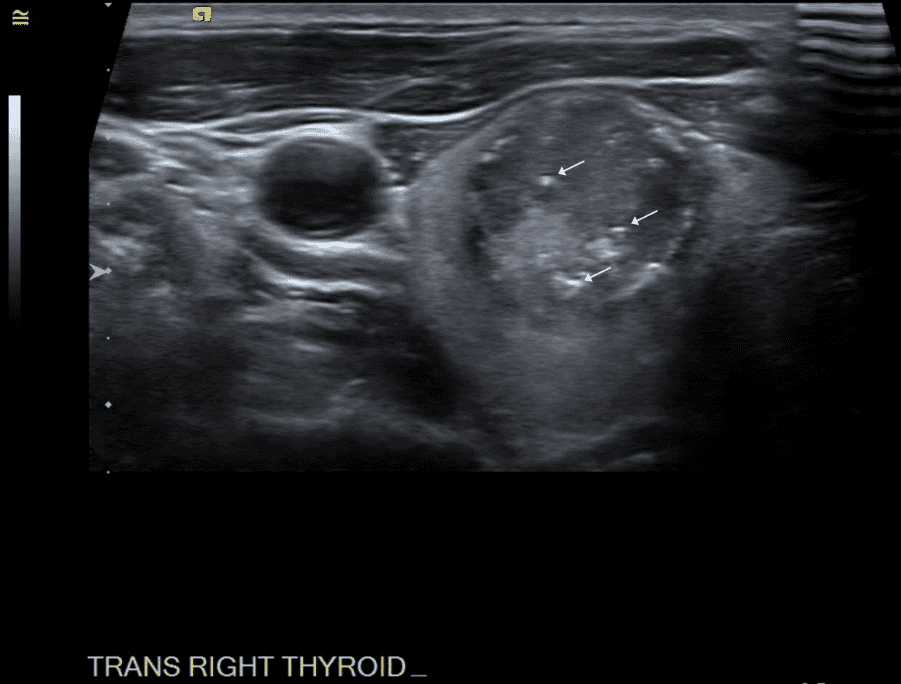 Transverse view of nodule within right thyroid lobe; white arrows denote microcalcifications.